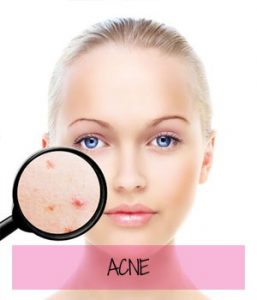 reduce acne at Sparx Beauty Salon, Winchester