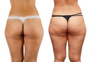 anti-cellulite-treatments, rf skin tightening, sparx Winchester laser clinic 