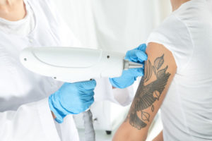 Laser Tattoo Removal Winchester Aesthetics Clinic