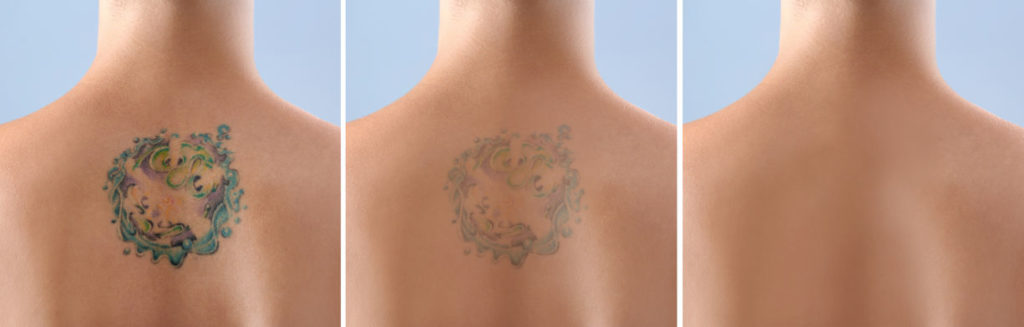 Hampshire Tattoo Removal Services Sparx Laser Clinic Winchester